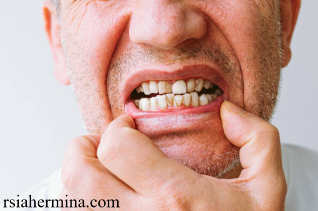 Penyebab Umum Masalah Mulut dan Gigi